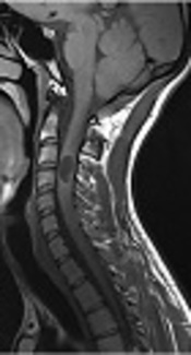 Intradural Intramedullary Spinal Hydatid Cyst Mimicking Cystic Malignancy: A Case Report