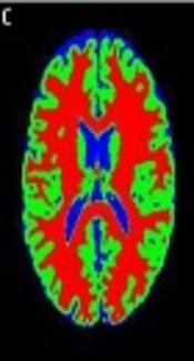 Improvement of MRI Brain Image Segmentation Using Fuzzy Unsupervised Learning