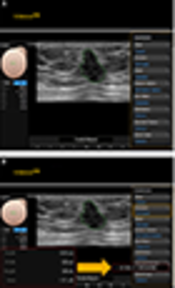 Comparison of the Diagnostic Performance of Breast Ultrasound and CAD Using BI-RADS Descriptors and Quantitative Variables