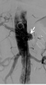 Delayed Pseudoaneurysm Rupture and Management After Covered Stent Placement for Post Pancreaticoduodenectomy Hemorrhage: A Case Report