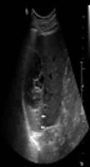 A Hepatic Cyst Complicated by Hemorrhage with Secondary Revascularization Mimicking Mucin-Producing Cystic Neoplasm: Radiologic-Pathologic Correlations