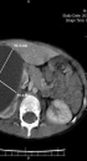 Renal Hydatid Cyst or a Simple Cyst? Report of a Rare Case