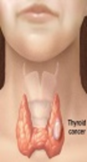 Thrombosis in Thyroid Cancer