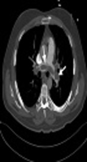 Investigating the Use and Optimization of Low Dose kV and Contrast Media in CT Pulmonary Angiography Examination