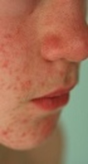 The Association Between Helicobacter pylori Infection and Rosacea
