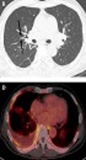 Immunoglobulin G4-Related Disease Unilaterally Involving the Pulmonary Interstitium and Pleura: A Case Report