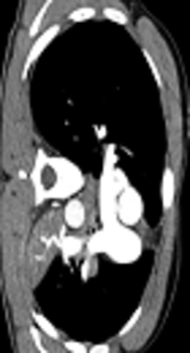 A 21-Year Old Male with Hemoptysis and Central Chest Pain