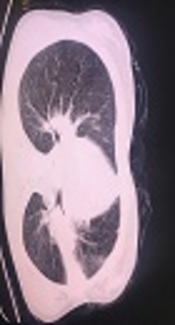 A Case of Primary Biliary Tuberculosis with Subsequent Pulmonary Presentation