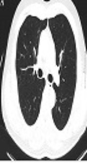 Differences of Low-Dose Chest Computed Tomography Findings Between Smokers and Nonsmokers Based on Smoking Cessation Program