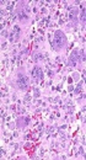 Varicose Vessels Within Pulmonary Metastasis of Giant Cell Tumor: Unusual Radiological Manifestation