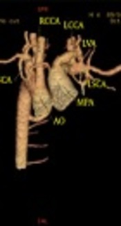 Right Sided Aortic Arch with Type C Aortic Arch Interruption: CT Angiography Findings