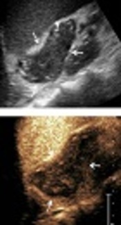 The Features of Adrenal Tuberculosis by Contrast-Enhanced Ultrasound