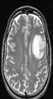 Diagnostic Efficacy of Perfusion Magnetic Resonance Imaging in Supratentorial Glioma Grading