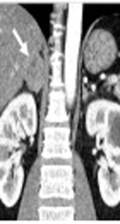 Adrenal Epithelioid Hemangioendothelioma: Case Report of an Unusual Adrenal Tumor and Diagnostic Implications of Adrenal CT