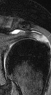 Association Between Subacromial Impingement and Acromiohumeral Distance on MRI