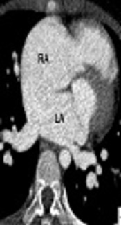 Drainage of the Inferior Vena Cava Into the Left Atrium with Atrial Septal Defect and Partial Anomalous Pulmonary Venous Return: Initial and Postoperative Computed Tomography (CT) Findings