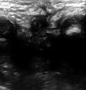 Ultrasound Guided Wire Localization of Anal Tract in Imperforate Anus