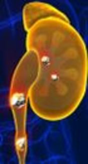 Recurrent Nephrolithiasis Leading to Renal Failure: A Neglected Primary Hyperparathyroidism