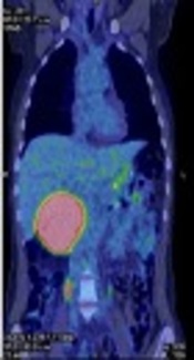 Contribution of 18F-FDG PET/CT in the Staging of Pancreatic Solid Pseudopapillary Neoplasms: A Case Report