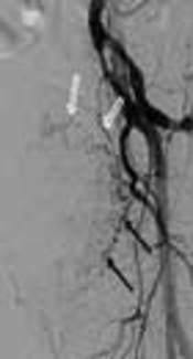 Superselective Embolization of Bilateral Inferior Vesical Arteries for the Management of Radiation-Induced Hemorrhagic Cystitis Refractory to Conventional Methods