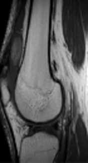 A Case of Infarcted Localized Tenosynovial Giant Cell Tumor of the Knee: Multimodality Imaging Features and Literature Review