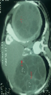Concurrent Hydatidosis of the Liver, Spleen and Breast: A Case Report