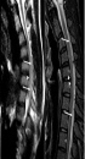 Hirayama Disease: Best Depicted in the Prone Position with Full-Flexion Cervical MRI in A Serial Trial