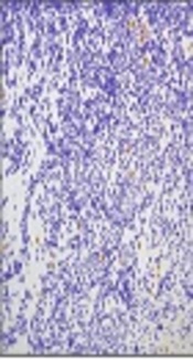 Expression of Pro-Apoptotic P53 Tumor Suppressor Gene in Pituitary Adenomas: Comparison with Anti-Apoptotic Bcl-2 Oncoprotein 