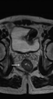 Clinical Feasibility Assessment of T3 Sub-Stage in Rectal Cancer Using MRI