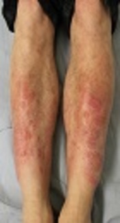 New Developmental Pattern of Lesions in Alcohol - Related Adult - Type Self - Healing Cutaneous Mucinosis: A Short Report and Review of the Literatures