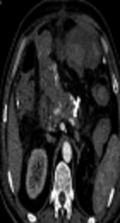 Transcatheter Arterial Embolization for Late Postpancreatectomy Hemorrhage of Unusual Origin (Dorsal Pancreatic Artery): A Report of Three Cases