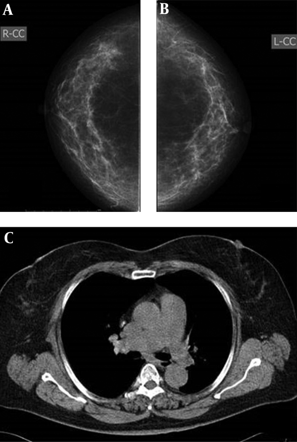 Imaging findings of a 57-year-old woman. A and B, Mammography, both radiologists classified bilateral breasts in category b. C, CT scan, defined as category c.