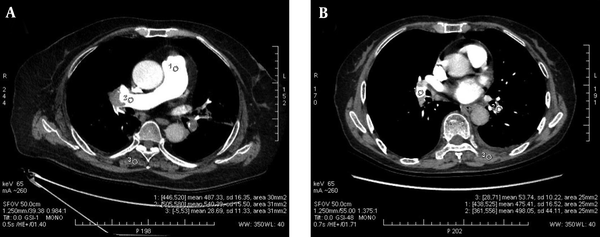 Example of region of interest (ROI) placement in CT pulmonary angiography (CTPA) images
