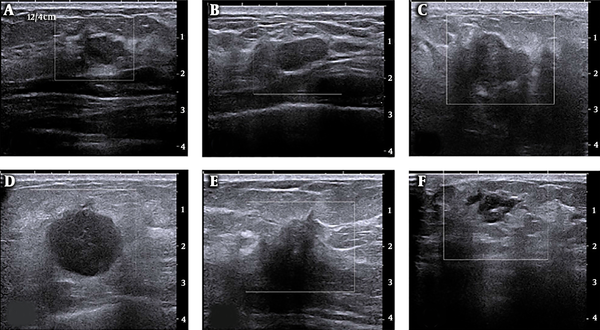 A-C, Original breast B-mode ultrasound shows benign lesions; and D-F, Malignant lesions.