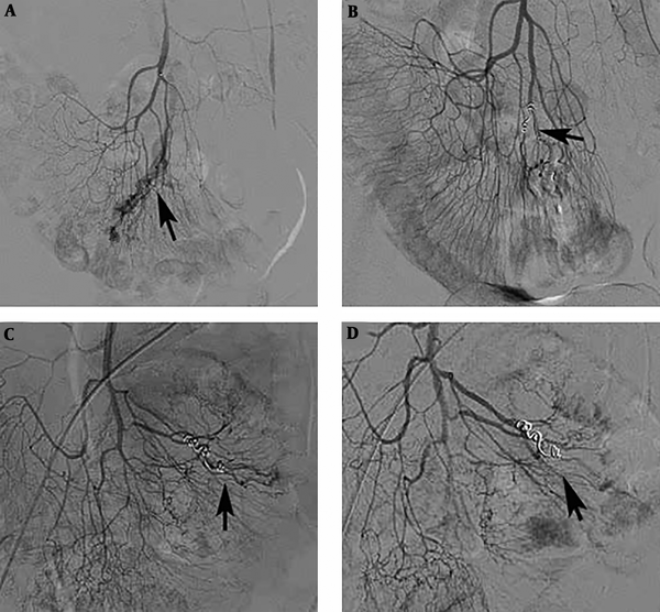 A 75-year-old patient with an ileal angiodysplasia (AD). A, After superselective catheterization of the ileal artery was performed, angiography showed abnormal vascular tufts and an early venous phase (arrow); B, Microcoils were placed in the abnormal inflow artery of the ileal AD after the injection of polyvinyl alcohol (PVA) particles (arrow); C, Ten months later, repeated angiography displayed that there was still some remnant of the ileal AD (arrow); D, After injecting PVA particles (350 - 560 µm) into the abnormal vessels, the lesions almost disappeared (arrow).