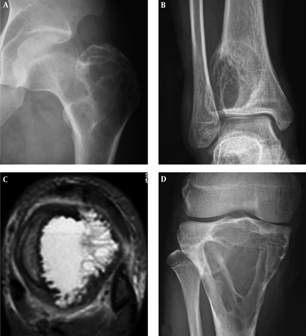 A, A 22-year-old man with an intertrochanteric aneurysmal bone cyst (ABC) with a bone destruction lesion and multiple cysts, clear margins and coarse septa; B and C, A 15-year-old girl with a tibial ABC; B, A Cystic lytic destructive lesion is seen in the distal tibia with clear margins and coarse septations; C, T2-weighted imaging (T2WI) magnetic resonance imaging demonstrated fluid-fluid levels; D, A 17-year-old boy with a tibial ABC and a cystic lytic lesion, thinned cortex, coarse septa and clear margins.