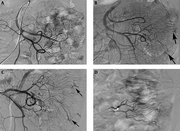 An 82-year-old patient with a jejunal angiodysplasia (AD). A, No positive findings were observed on the first angiography; B and C, After 1 week, repeated angiography indicated abnormal vascular tufts and an early venous phase at the distal branch of the jejunal artery (arrows); D, Polyvinyl alcohol (PVA) particles (350 - 560 µm) and microcoils were used to embolize the abnormal blood vessels.