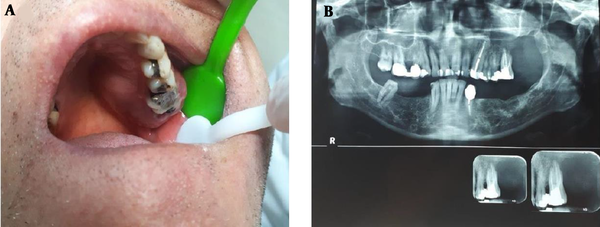 Clinical view of the patient with a painful enlarging mass on left maxillary bone extending from the midline to the depth of vestibule (A). Panoramic view of the patient with a destructive lesion with ill-defined borders on posterior part of left maxillary bone (B).