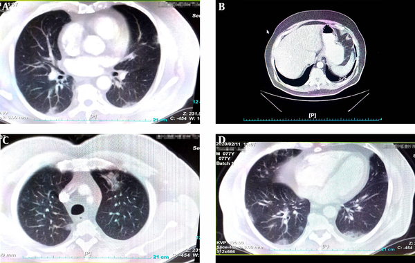 Chest CT scan (transverse plane) of 74-year-old man with COVID-19 as revealed bilateral peripheral ground glass, crazy paving and small consolation opacities