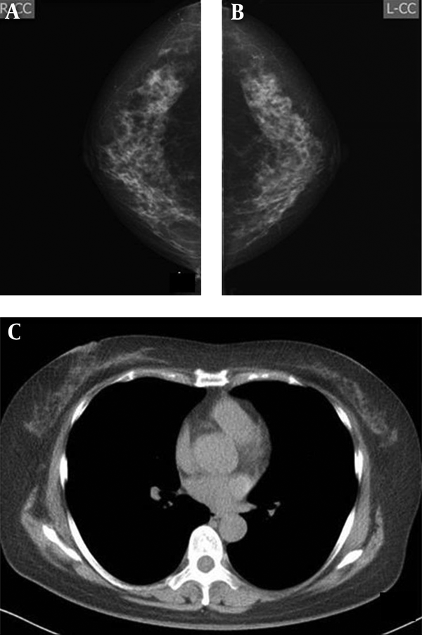 Imaging findings of a 54-year-old woman. A and B, Mammography, in which both radiologists classified bilateral breasts in category c on the mammogram C, CT scan, in which category b was defined.