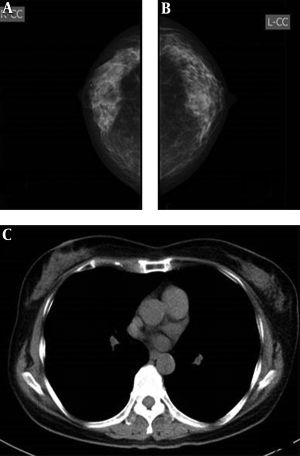 Imaging findings of a 57-year-old woman. A and B, mammography, both radiologists classified bilateral breasts in category c. C, CT scan, classified as category c.