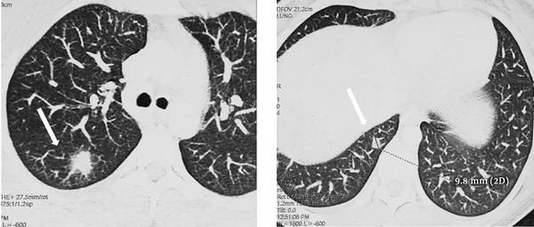 Axial sections of the thoracic computed tomography scan showing bilateral lung nodules from 6 to 18 mm (arrows)