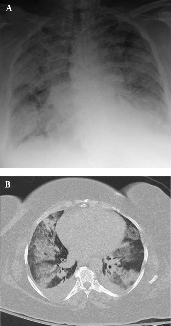 A, Chest X-ray showed diffused ground-glass opacity (GGO) and consolidation in both lungs, with a “white lung” appearance; B, multifocal GGO in both lungs with patchy consolidation, multi-segmental pulmonary distribution, air bronchogram, and bilateral pleural effusion.