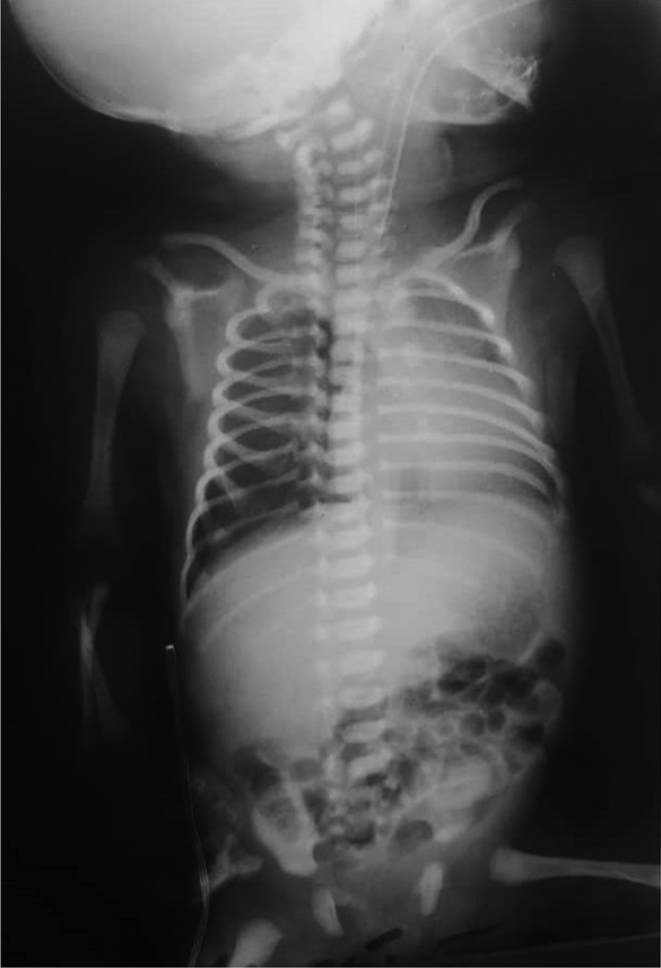 The second chest X-ray of neonate at first birth of day after injection of second dose of surfactant: mild hyperinflation that was decreased in comparison to previous CXR