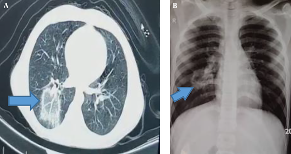 A, The computerized tomography scan showed a reverse halo sign; B, the chest X-ray showed mass-like opacity with central lucency.