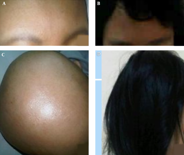 A and C, alopecia totalis (first visit at 2012), B and D, complete remission (2014)