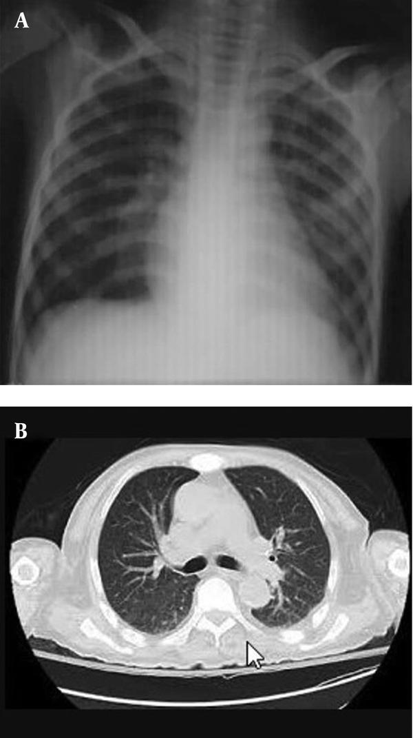 A and B, Four days after starting dexamethasone, chest c-ray and CT showed disappearance of the lung infiltrations