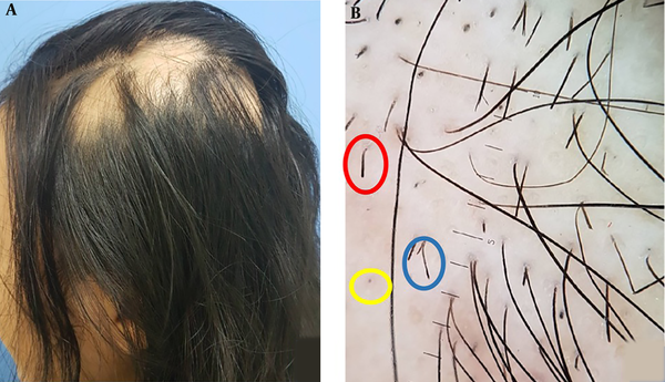 A, patchy alopecia (August 2018); B, trichoscopic findings consisted of black dots (yellow circle), exclamation mark hair (red circle) and upright re-growing hair (blue circle)