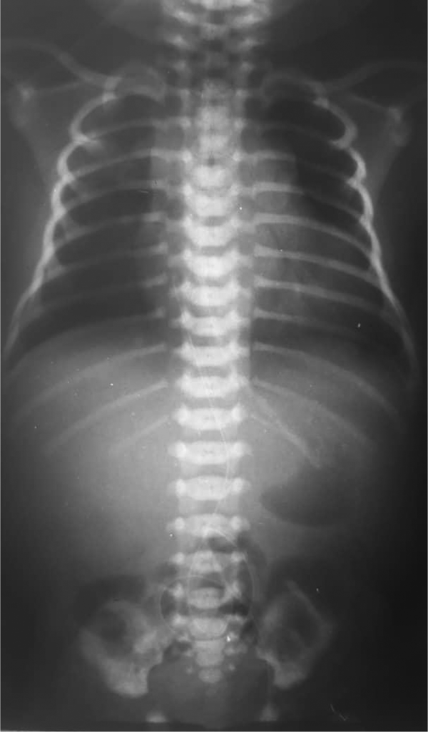 The third chest x-ray of neonate at fifth day of birth: the lung tissue had normal pattern
