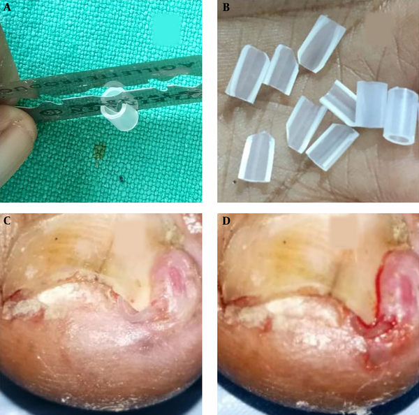 (A) A small polytube is being split. (B) Beveled polytube before the splinting. (C) The polytube is being placed through hyponychium in the nail canal. (D) The polytube is placed in the canal to splint ingrown nail.